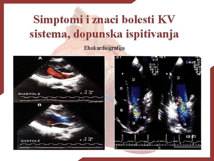 Simptomi i znaci bolesti KV sistema, dopunska ispitivanja Ehokardiografija 