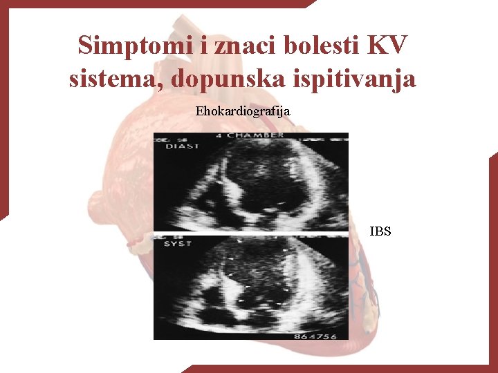 Simptomi i znaci bolesti KV sistema, dopunska ispitivanja Ehokardiografija IBS 