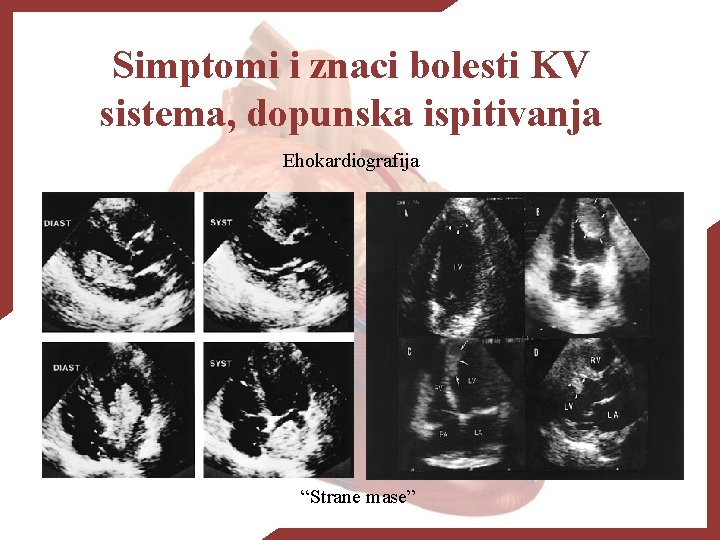 Simptomi i znaci bolesti KV sistema, dopunska ispitivanja Ehokardiografija “Strane mase” 
