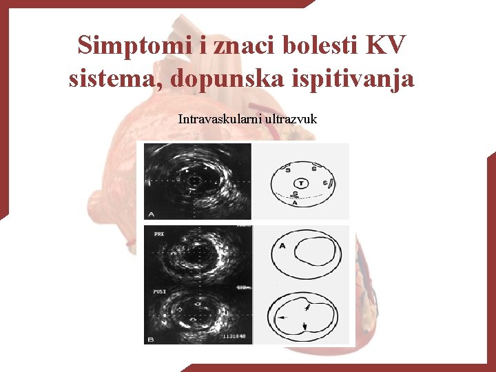 Simptomi i znaci bolesti KV sistema, dopunska ispitivanja Intravaskularni ultrazvuk 