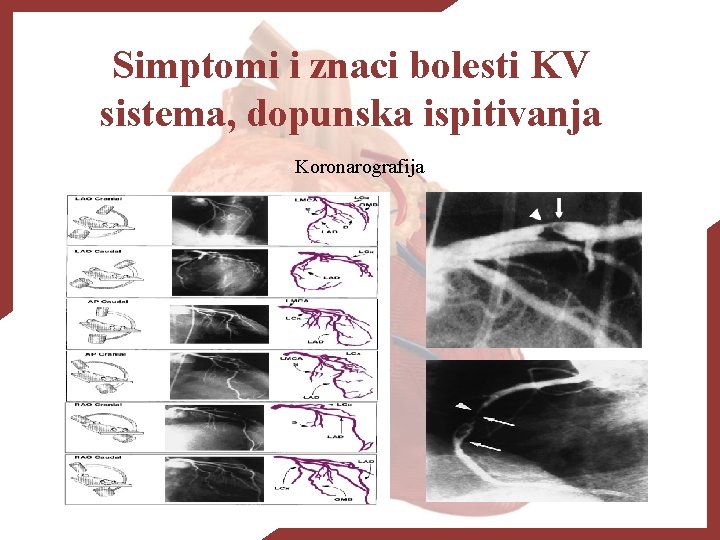 Simptomi i znaci bolesti KV sistema, dopunska ispitivanja Koronarografija 