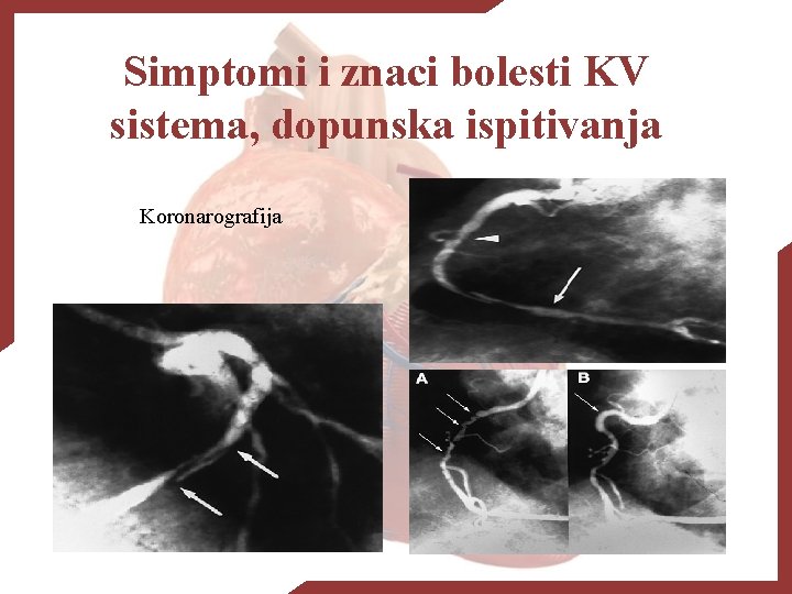 Simptomi i znaci bolesti KV sistema, dopunska ispitivanja Koronarografija 