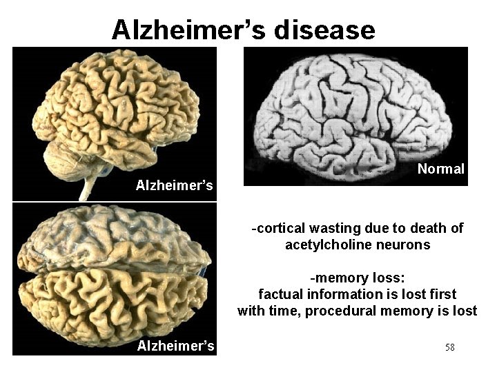 Alzheimer’s disease Normal Alzheimer’s -cortical wasting due to death of acetylcholine neurons -memory loss: