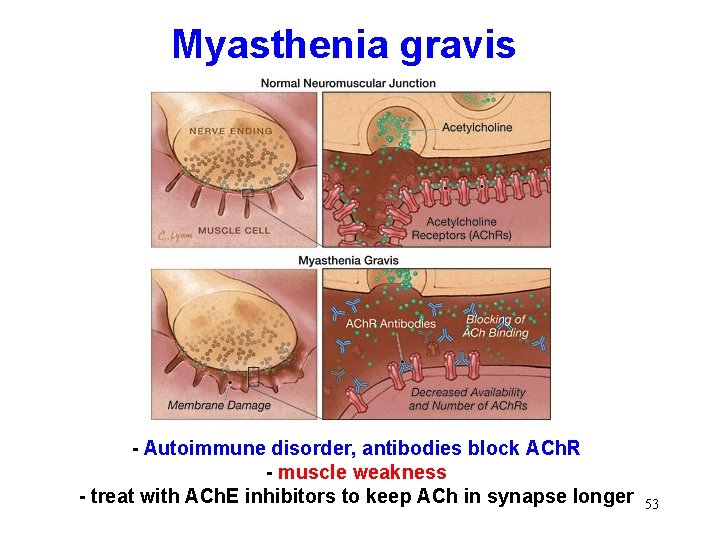 Myasthenia gravis - Autoimmune disorder, antibodies block ACh. R - muscle weakness - treat