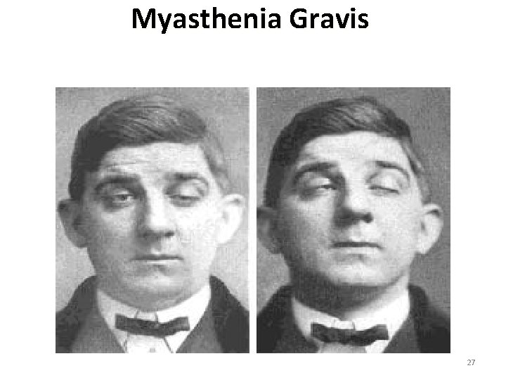 Myasthenia Gravis 27 
