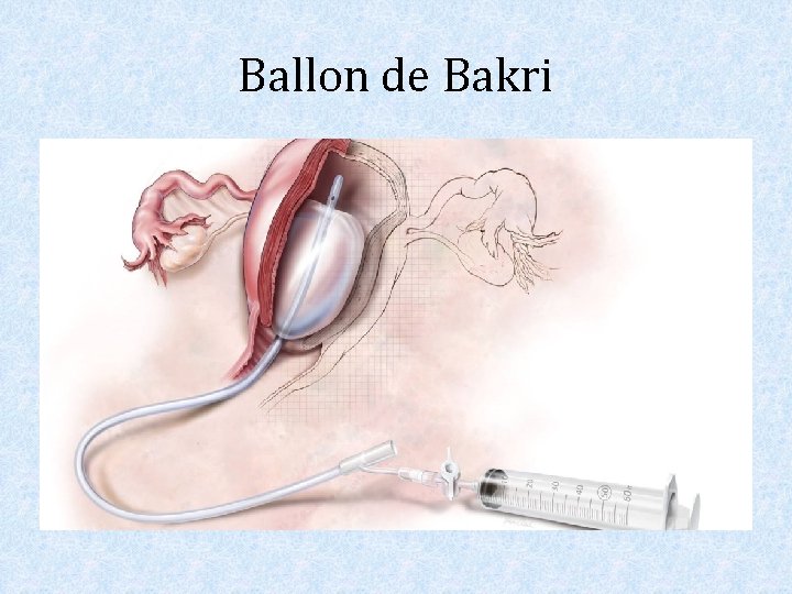 Ballon de Bakri 