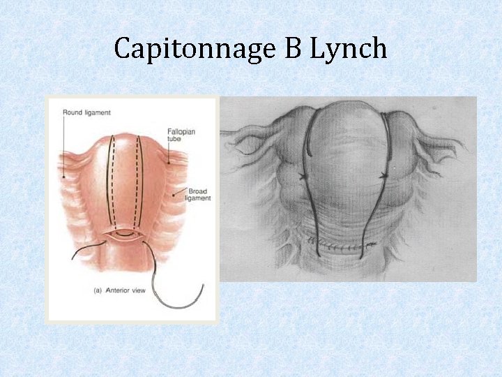 Capitonnage B Lynch 