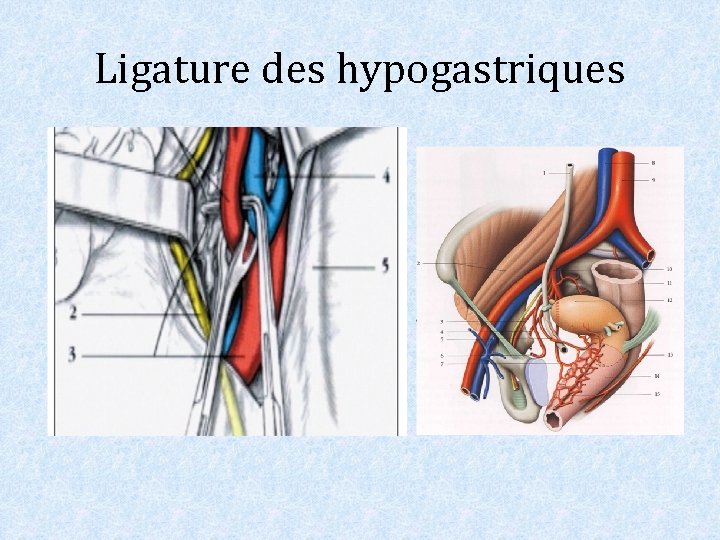 Ligature des hypogastriques 