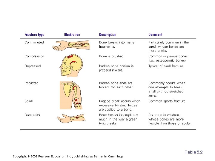 Common Types of Fractures Table 5. 2 Copyright © 2006 Pearson Education, Inc. ,