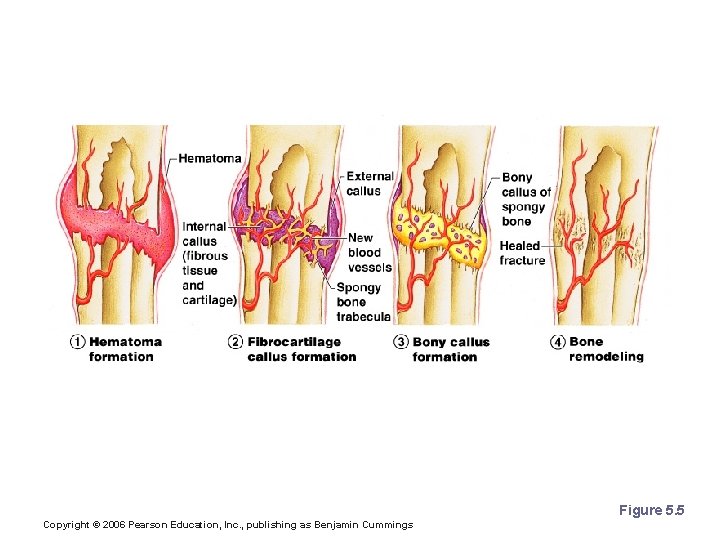 Stages in the Healing of a Bone Fracture Figure 5. 5 Copyright © 2006