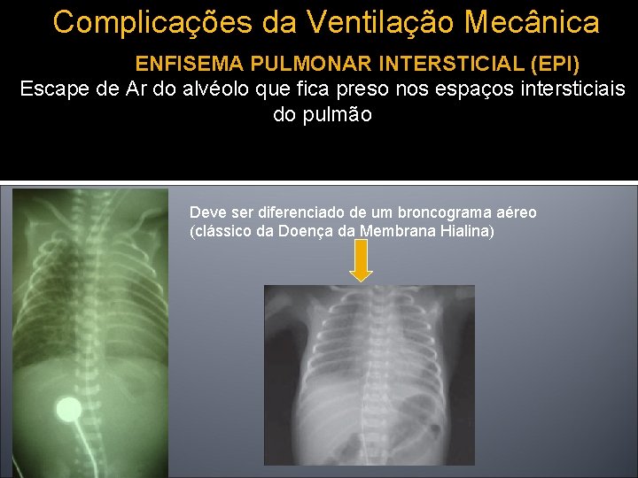 Complicações da Ventilação Mecânica ENFISEMA PULMONAR INTERSTICIAL (EPI) Escape de Ar do alvéolo que