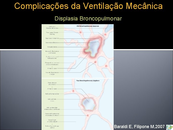 Complicações da Ventilação Mecânica Displasia Broncopulmonar - Baraldi E, Filipone M, 2007 