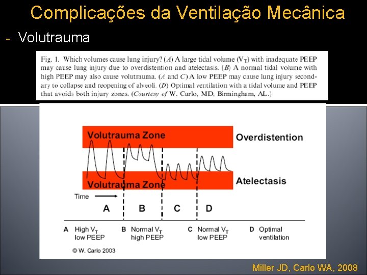 Complicações da Ventilação Mecânica - Volutrauma Miller JD, Carlo WA, 2008 