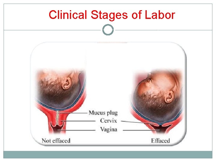 Clinical Stages of Labor Clinical Stages of Labor