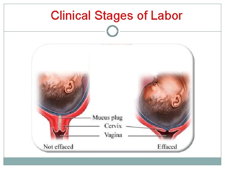 Clinical Stages of Labor 