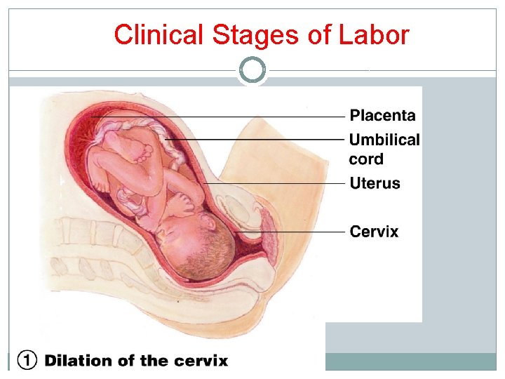 Clinical Stages of Labor Clinical Stages of Labor