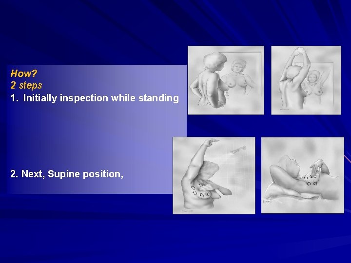 How? 2 steps 1. Initially inspection while standing 2. Next, Supine position, 