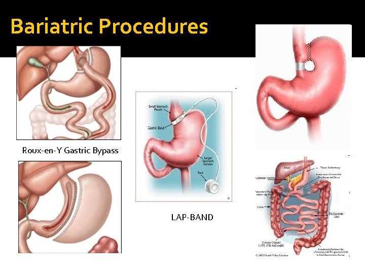 Bariatric Procedures Roux-en-Y Gastric Bypass LAP-BAND 