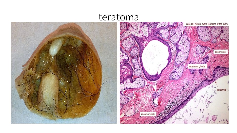 teratoma 