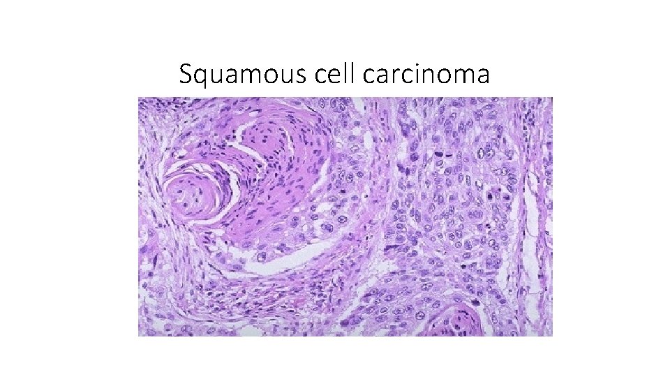 Squamous cell carcinoma 