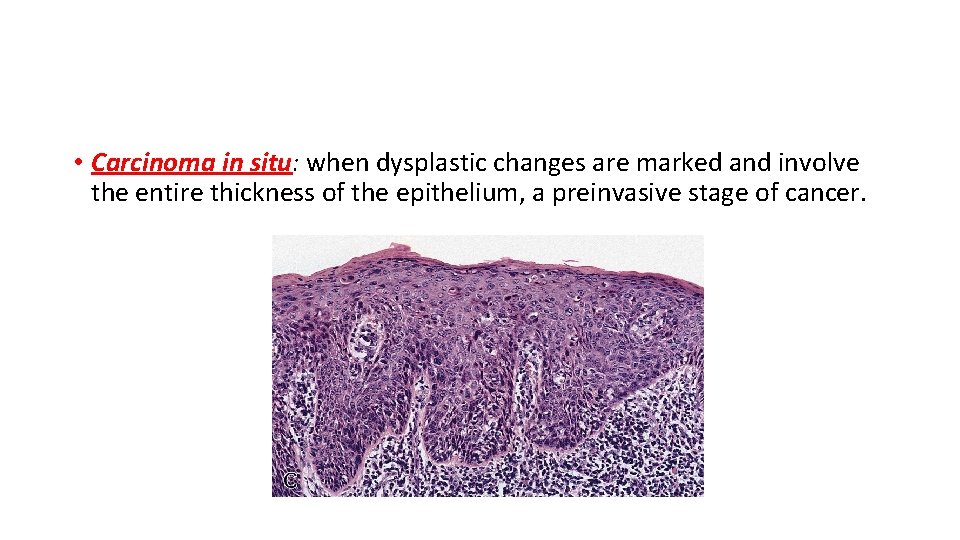  • Carcinoma in situ: when dysplastic changes are marked and involve the entire