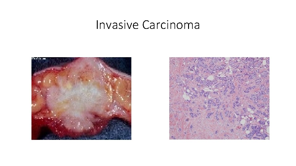 Invasive Carcinoma 