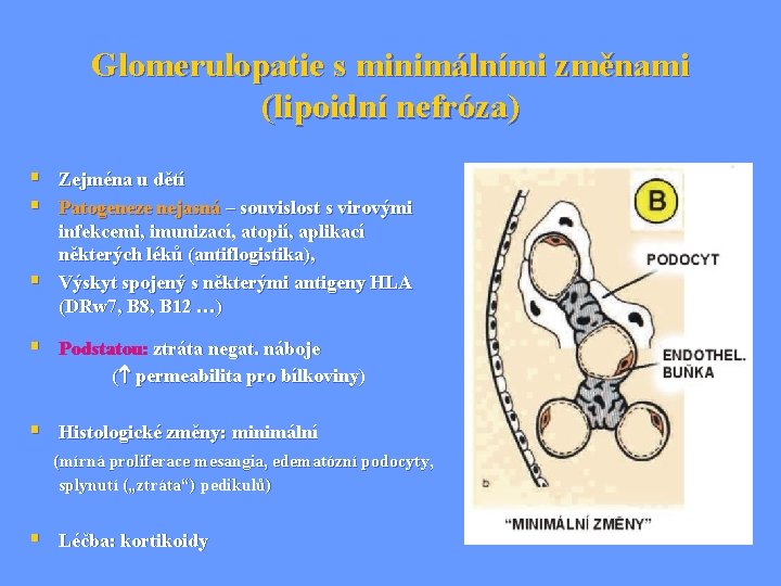 Glomerulopatie s minimálními změnami (lipoidní nefróza) § Zejména u dětí § Patogeneze nejasná –