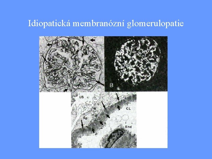 Idiopatická membranózní glomerulopatie 