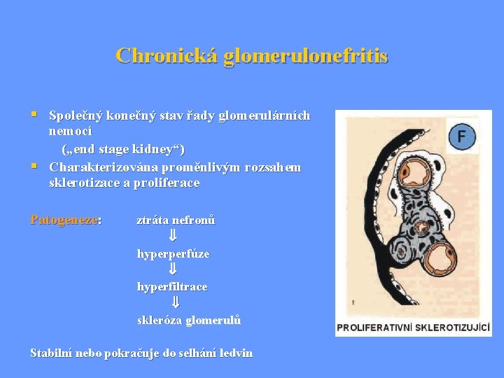 Chronická glomerulonefritis § Společný konečný stav řady glomerulárních § nemocí („end stage kidney“) Charakterizována