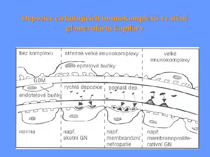 Depozice cirkulujících imunokomplexů ve stěně glomerulární kapiláry 