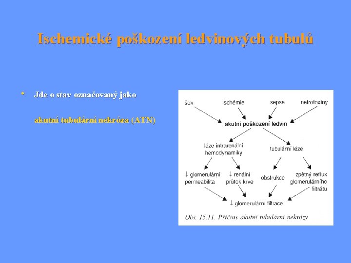 Ischemické poškození ledvinových tubulů • Jde o stav označovaný jako akutní tubulární nekróza (ATN)