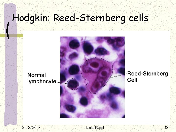 Hodgkin: Reed-Sternberg cells 24/2/2019 leuke 19. ppt 13 