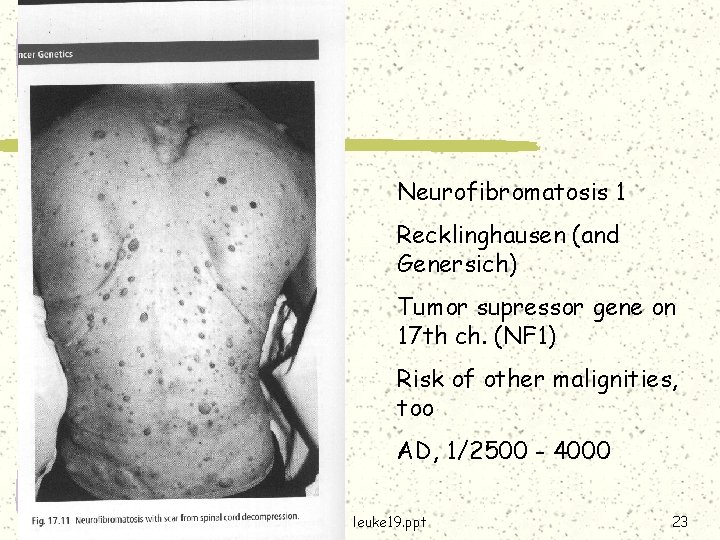 Neurofibromatosis 1 Recklinghausen (and Genersich) Tumor supressor gene on 17 th ch. (NF 1)