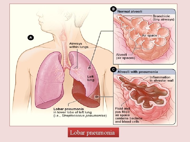 Lobar pneumonia 