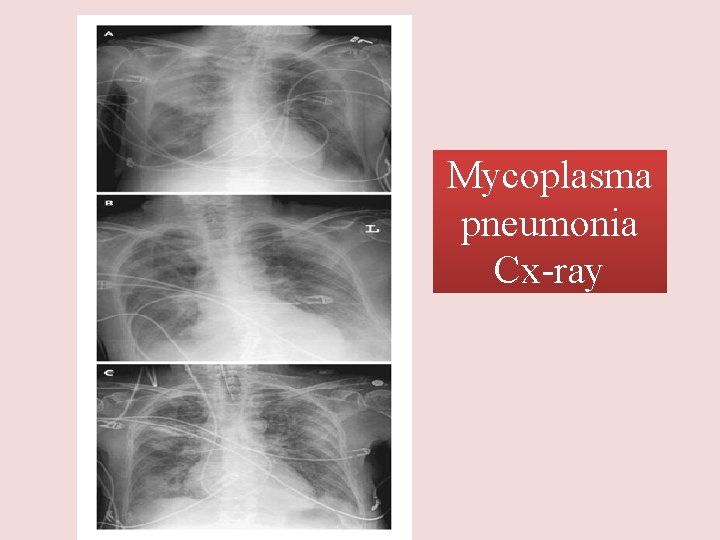 Mycoplasma pneumonia Cx-ray 