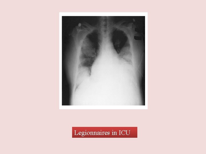 Legionnaires in ICU 