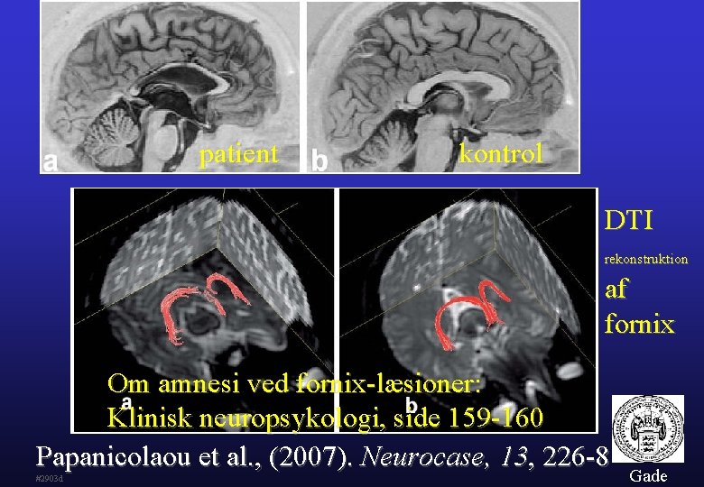 patient kontrol DTI rekonstruktion af fornix Om amnesi ved fornix-læsioner: Klinisk neuropsykologi, side 159