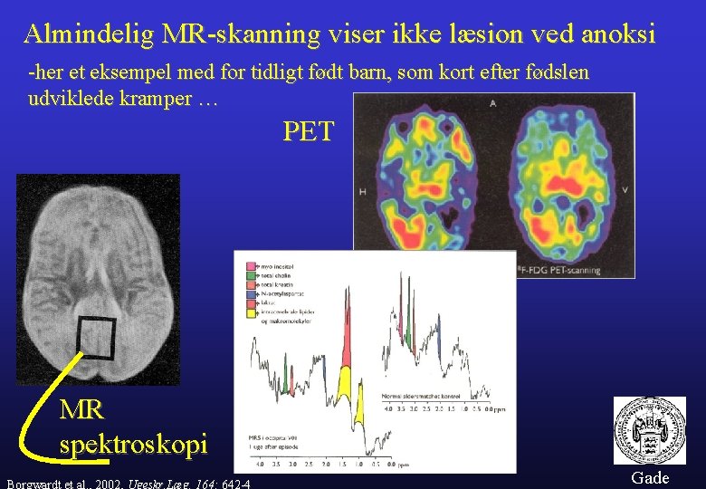 Almindelig MR-skanning viser ikke læsion ved anoksi -her et eksempel med for tidligt født