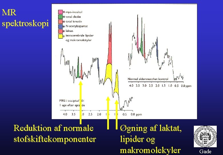 MR spektroskopi Reduktion af normale stofskiftekomponenter Øgning af laktat, lipider og makromolekyler Gade 