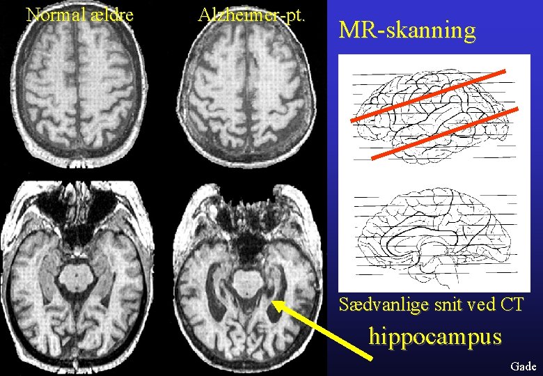 Normal ældre Alzheimer-pt. MR-skanning Sædvanlige snit ved CT hippocampus Gade 