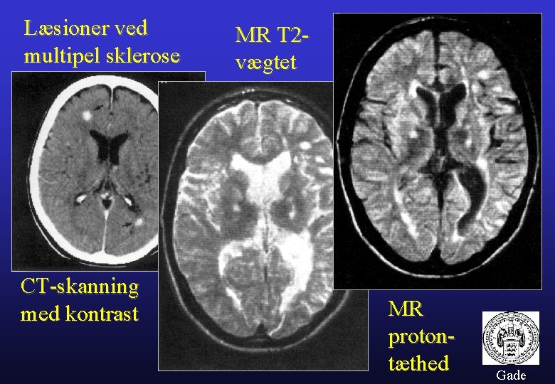 Læsioner ved multipel sklerose CT-skanning med kontrast MR T 2 vægtet MR protontæthed Gade