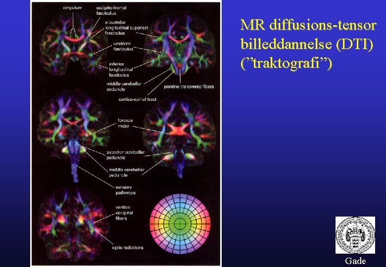 MR diffusions-tensor billeddannelse (DTI) (”traktografi”) Gade 