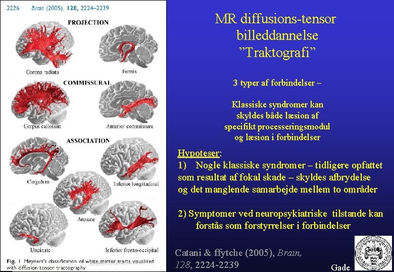 MR diffusions-tensor billeddannelse ”Traktografi” 3 typer af forbindelser – Klassiske syndromer kan skyldes både
