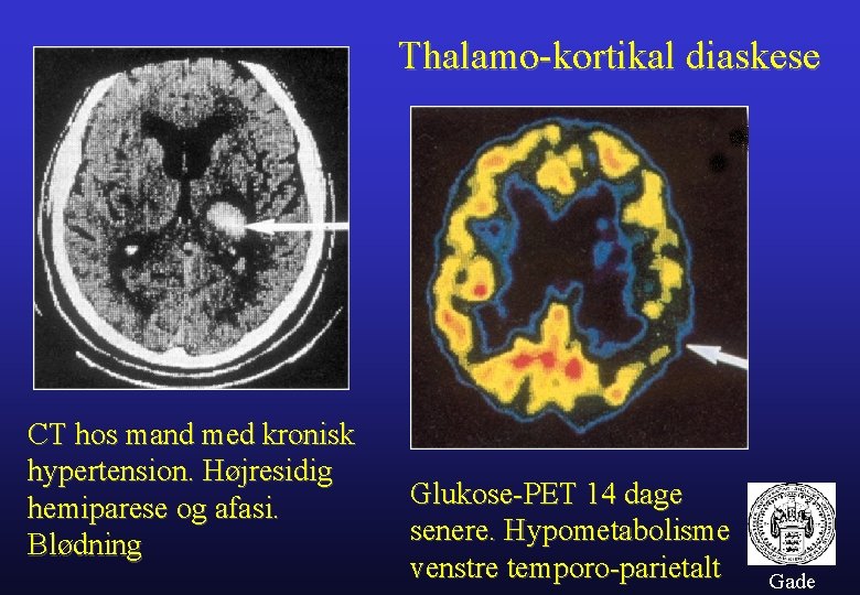 Thalamo-kortikal diaskese CT hos mand med kronisk hypertension. Højresidig hemiparese og afasi. Blødning Glukose-PET