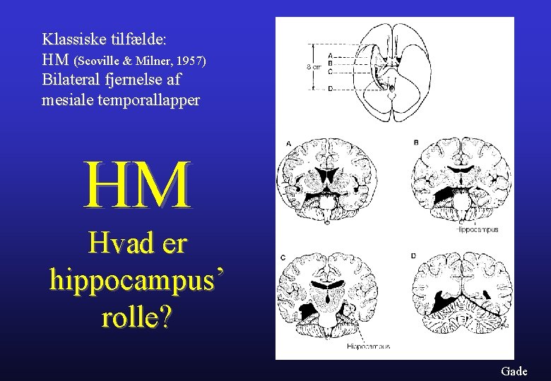 Klassiske tilfælde: HM (Scoville & Milner, 1957) Bilateral fjernelse af mesiale temporallapper HM Hvad