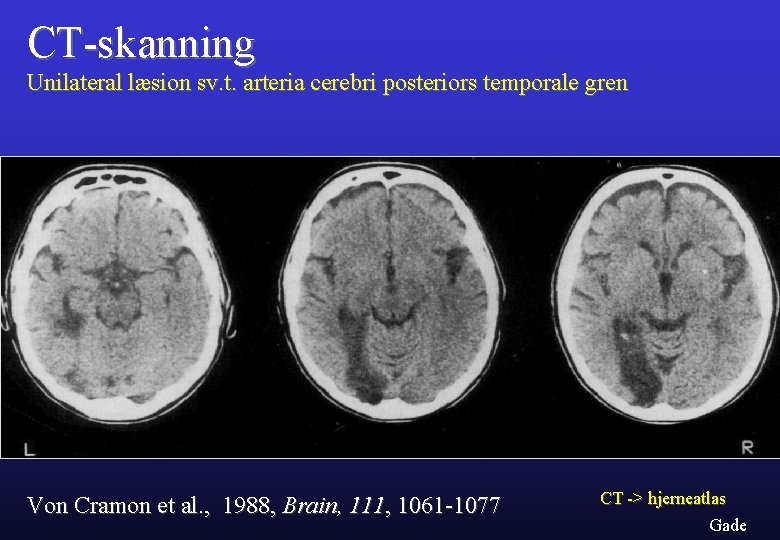 CT-skanning Unilateral læsion sv. t. arteria cerebri posteriors temporale gren Von Cramon et al.