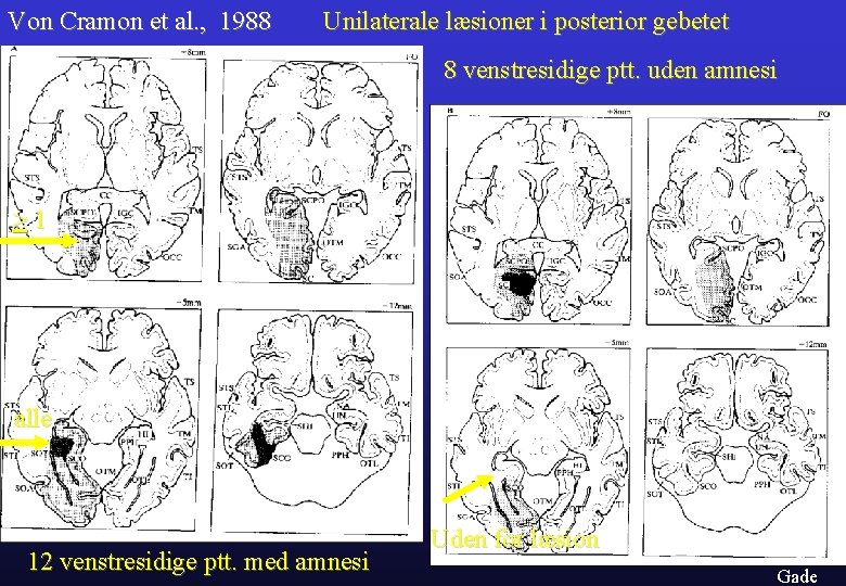 Von Cramon et al. , 1988 Unilaterale læsioner i posterior gebetet 8 venstresidige ptt.