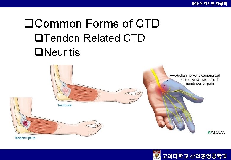 IMEN 315 인간공학 q. Common Forms of CTD q. Tendon-Related CTD q. Neuritis 고려대학교