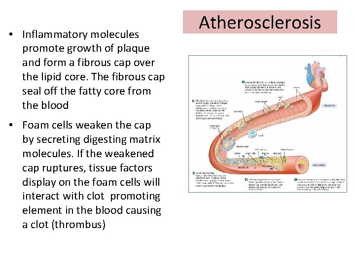  • Inflammatory molecules promote growth of plaque and form a fibrous cap over