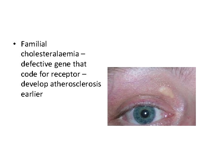  • Familial cholesteralaemia – defective gene that code for receptor – develop atherosclerosis
